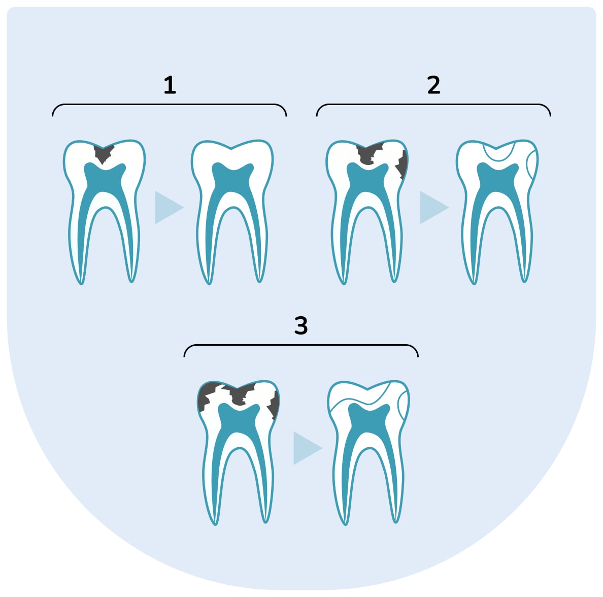 Léčba zubního kazu v Praze