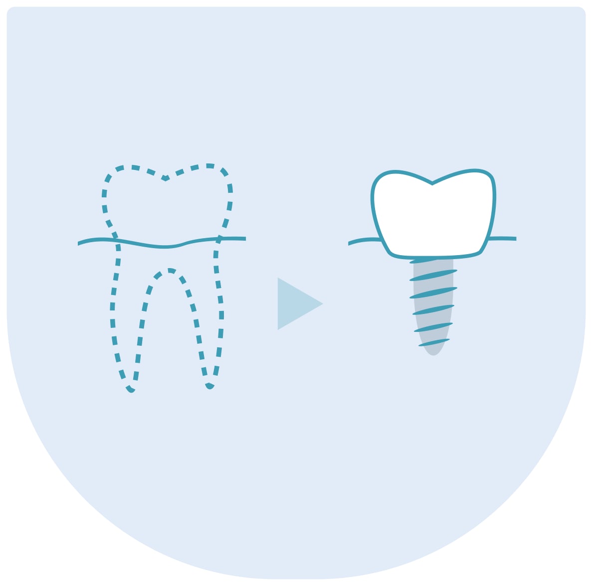 Zubní implantáty v Praze