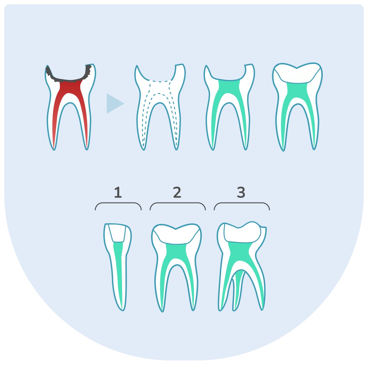 Endodoncie: Léčení kořenových kanálků